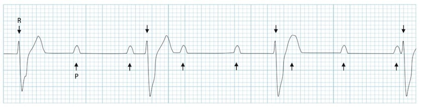 ECG rhythm strip example of third-degree complete heart block
