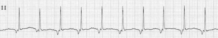 ECG rhythm strip example of accelerated junctional rhythm