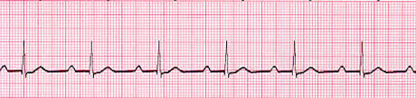 ECG rhythm strip example of first-degree AV block