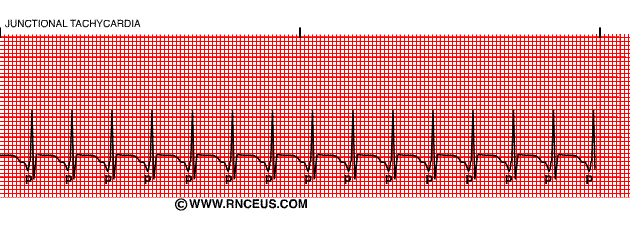 ECG rhythm strip example of junctional tachycardia