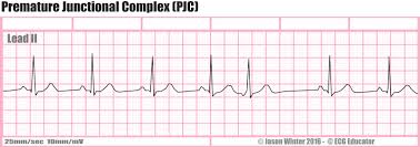 ECG rhythm strip example of a premature junctional contraction