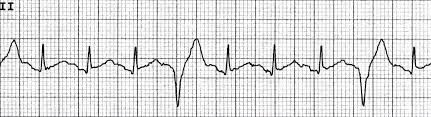 ECG rhythm strip example of premature ventricular contractions (PVCs)