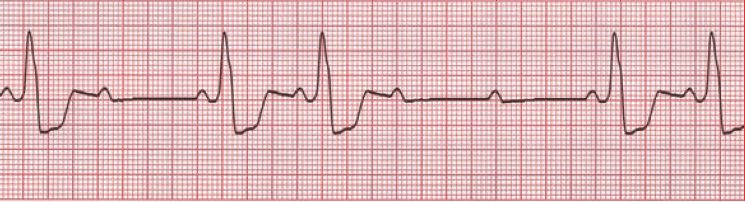 ECG rhythm strip example of second-degree AV block Mobitz II