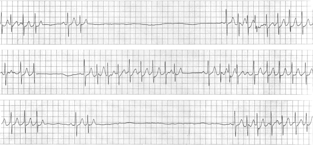 ECG rhythm strip example associated with sick sinus syndrome