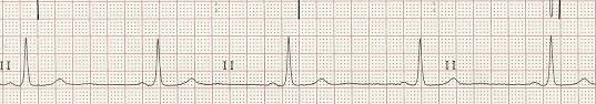 ECG rhythm strip example of sinus bradycardia