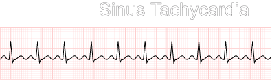 ECG rhythm strip example of sinus tachycardia