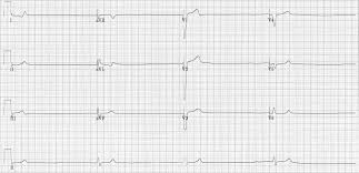 ECG rhythm strip example of ventricular escape or idioventricular rhythm