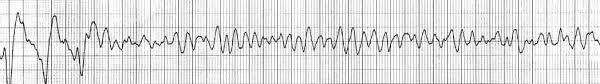 ECG rhythm strip example of ventricular fibrillation