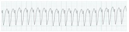 ECG rhythm strip example of monomorphic ventricular tachycardia