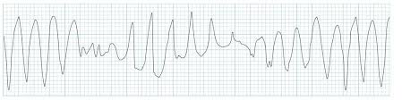 ECG rhythm strip example of polymorphic ventricular tachycardia