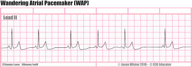 ECG rhythm strip example of wandering atrial pacemaker